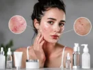 Acne e Problemas de Pele